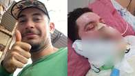 Jovem que se queimou ao fazer bife na chapa espera há 5 meses por exame de broncospia
