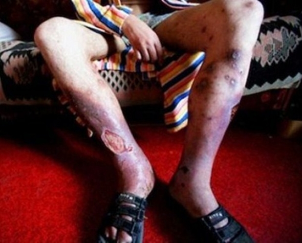 Nova droga corrói pele e músculos e deixa ossos à mostra
