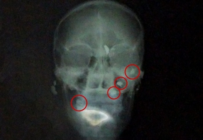 Homem leva 5 tiros e chega a hospital andando a pÃ© em ChapadÃ£o do Sul