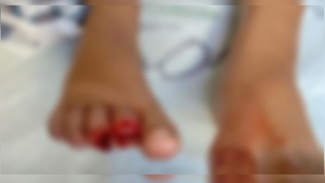 Criança de 9 anos tem dedos dos pés arrancados após ataque de piranhas