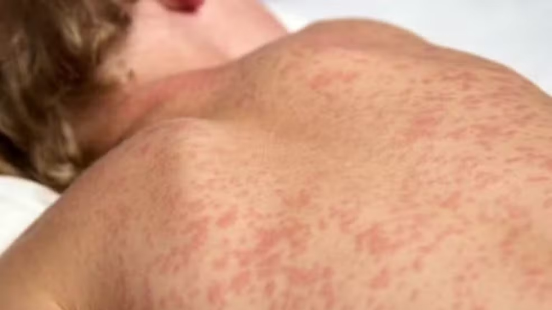 Surto de sarampo na Bol&iacute;via e no Paraguai coloca estado brasileiro em alerta