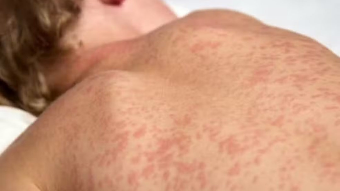 Beb&ecirc; de 8 meses &eacute; investigado como caso suspeito de sarampo em Mato Grosso do Sul