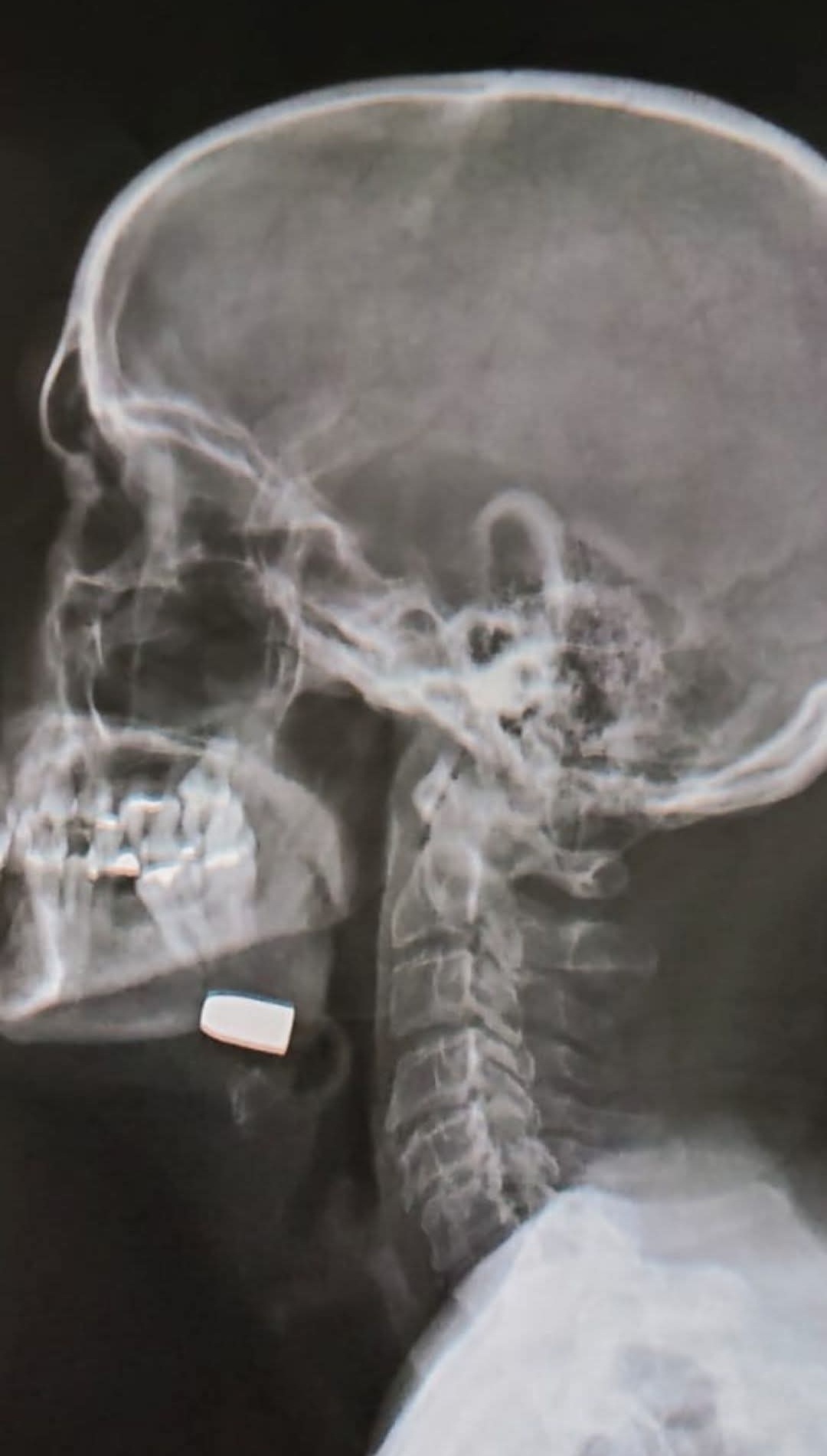 Pastor &eacute; atingido por bala perdida dentro de casa, passa por cirurgia e est&aacute; fora de perigo