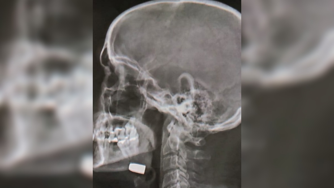 Filha denuncia falha no atendimento da UPA a v&iacute;tima de bala perdida em Sidrol&acirc;ndia