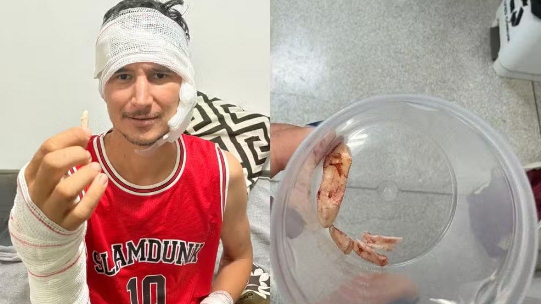 Pe&atilde;o guarda como amuleto garra de on&ccedil;a que ficou cravada em perna durante ataque 