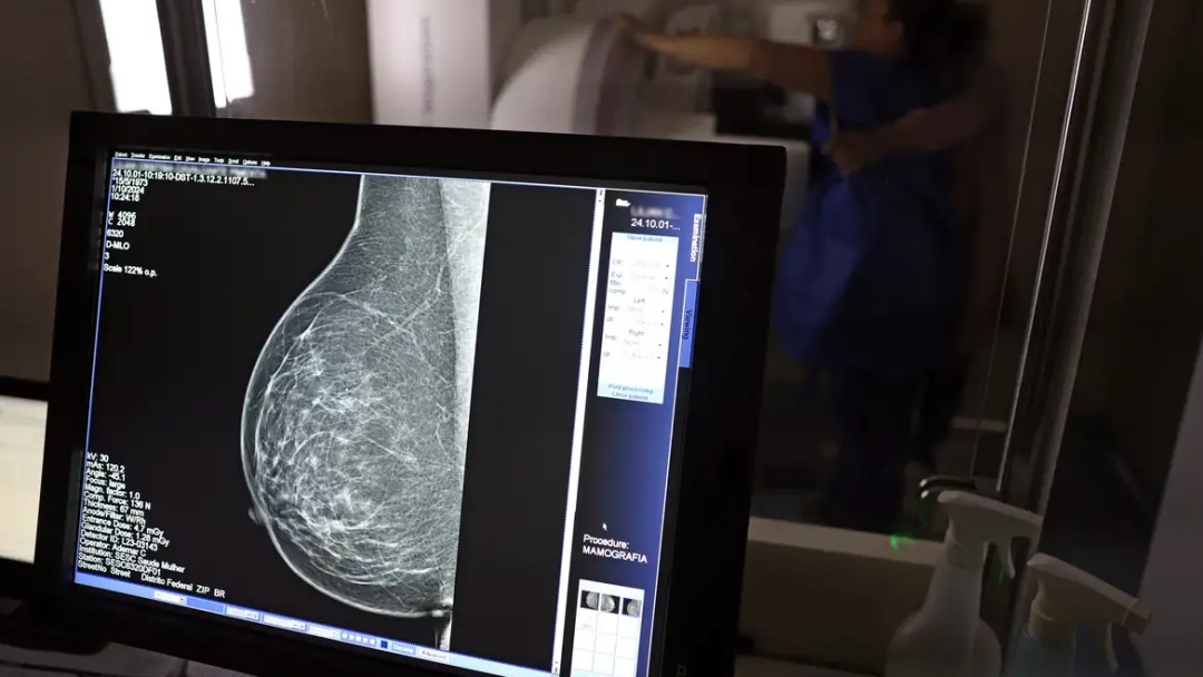 Falta de acesso a mam&oacute;grafos limita preven&ccedil;&atilde;o do c&acirc;ncer de mama