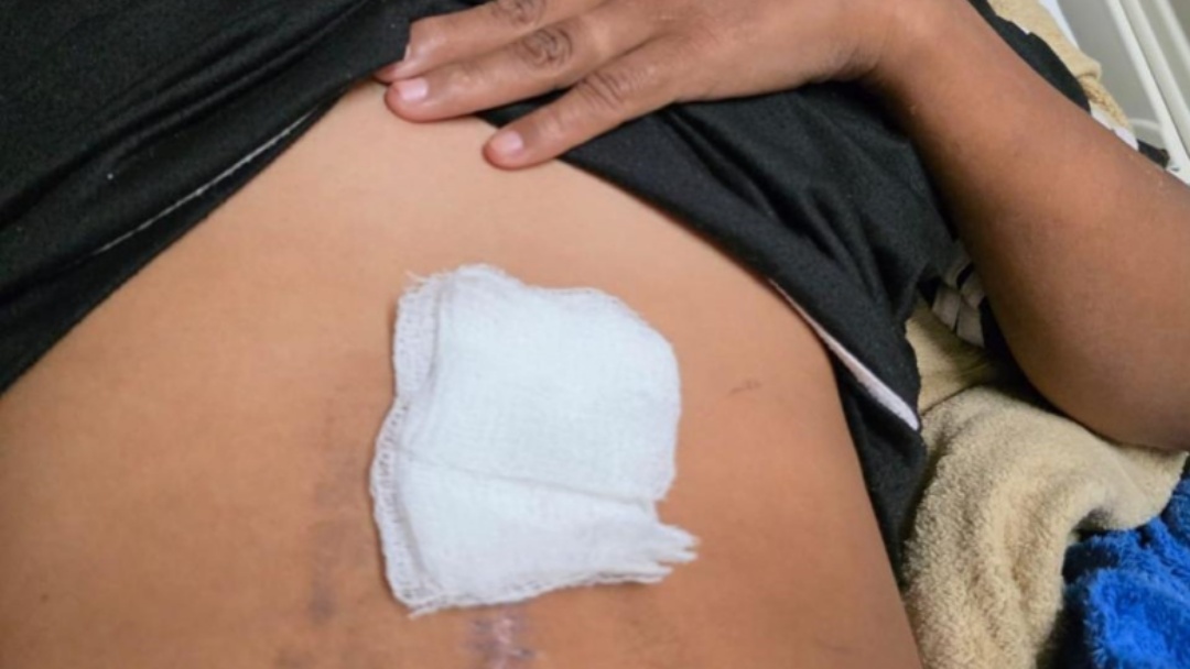 Mulher tem gaze esquecida no abd&ocirc;men ap&oacute;s cez&aacute;ria e volta a ser internada no HU-UFGD