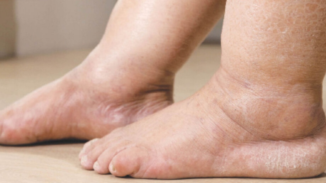 Pesquisa indica que 12,3% das mulheres brasileiras podem ter doen&ccedil;a &ldquo;invis&iacute;vel&rdquo;