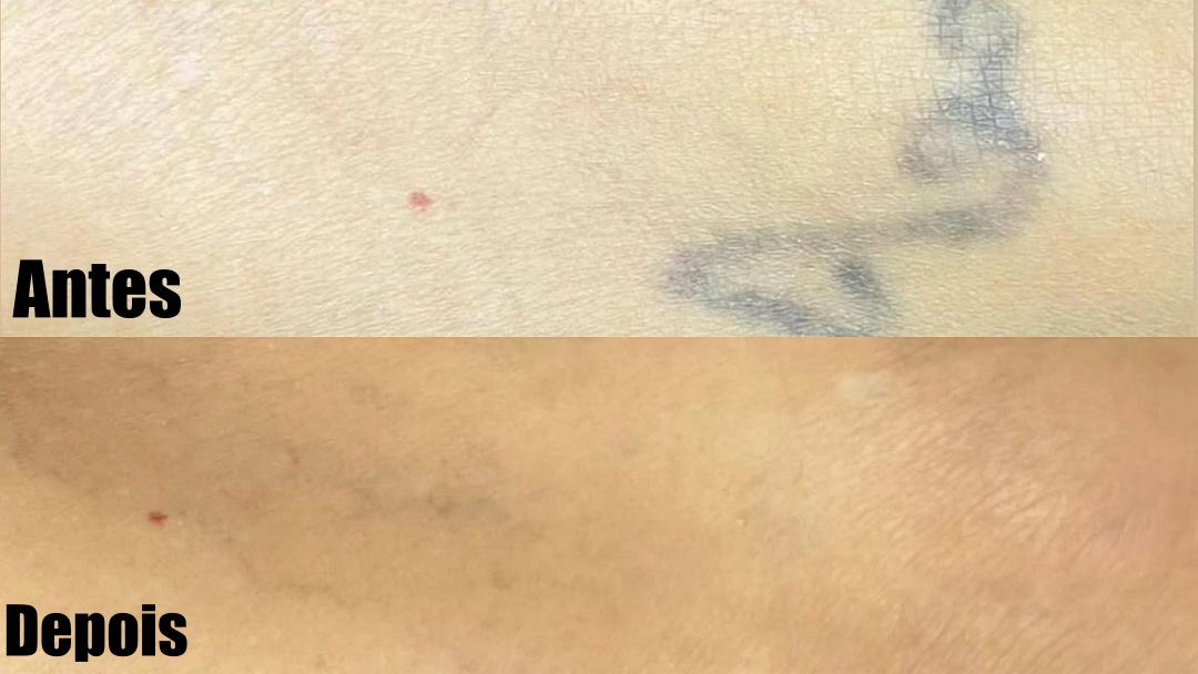 Domingo e Segunda tem depila&ccedil;&atilde;o a laser com Dayanne Kommers; veja os benef&iacute;cios e outros tratamentos dispon&iacute;veis