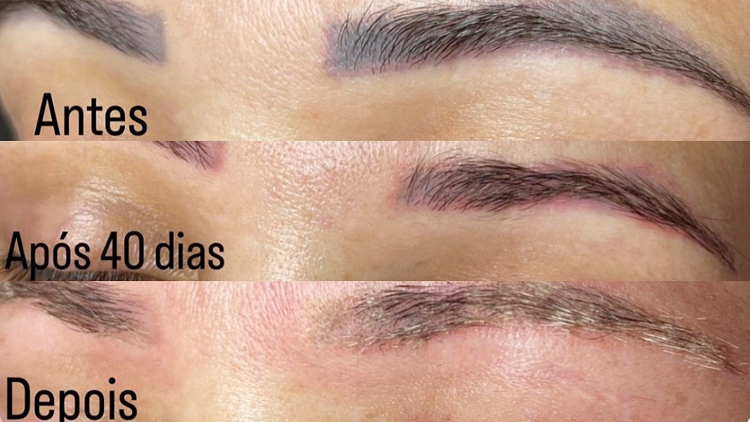 Domingo e Segunda tem depila&ccedil;&atilde;o a laser com Dayanne Kommers; veja os benef&iacute;cios e outros tratamentos dispon&iacute;veis