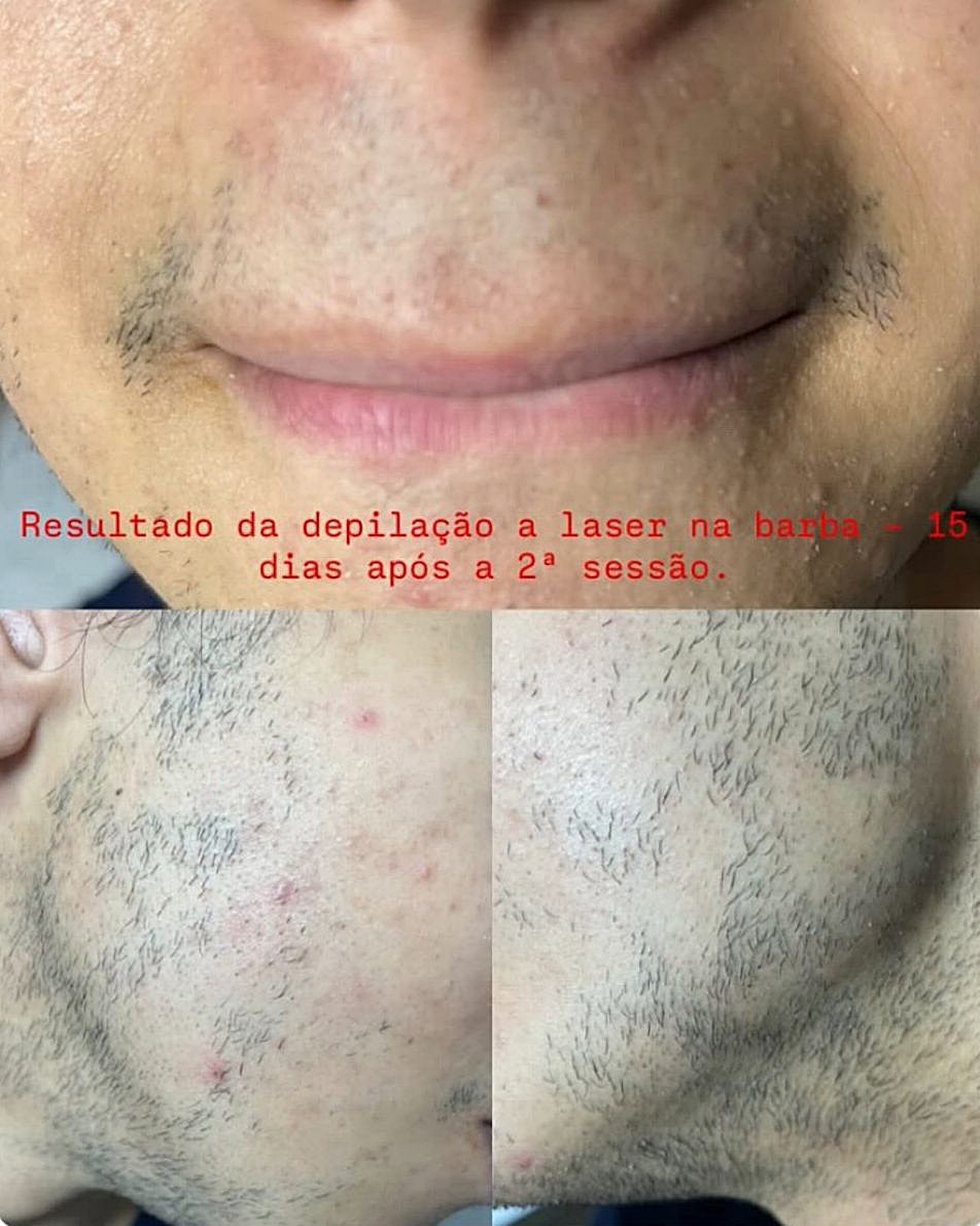 Domingo e Segunda tem depila&ccedil;&atilde;o a laser com Dayanne Kommers; veja os benef&iacute;cios e outros tratamentos dispon&iacute;veis