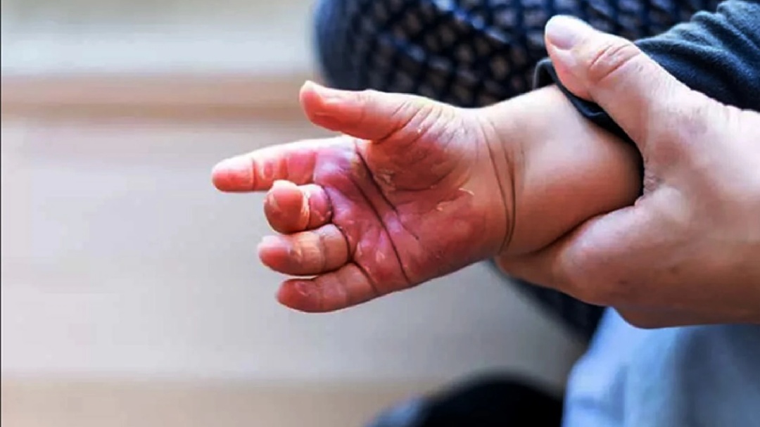 Mato Grosso do Sul tem 57 casos de queimaduras em crianças