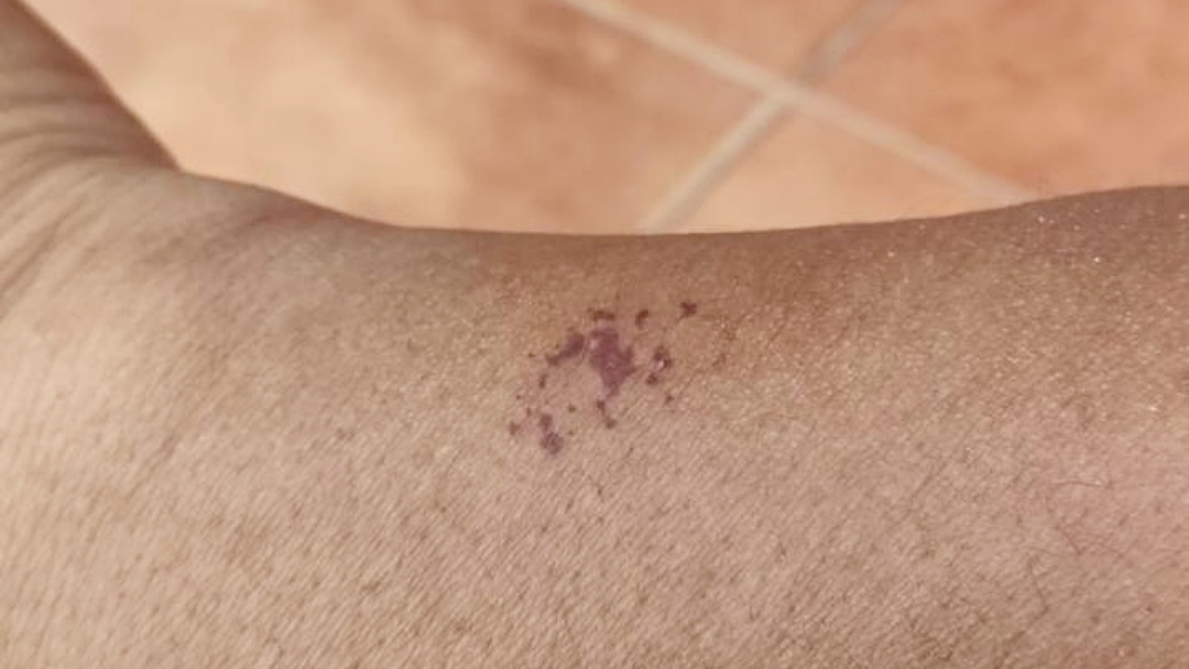 Moradores do S&atilde;o Bento relatam invas&atilde;o de taturanas e cobram a&ccedil;&atilde;o urgente da Sa&uacute;de