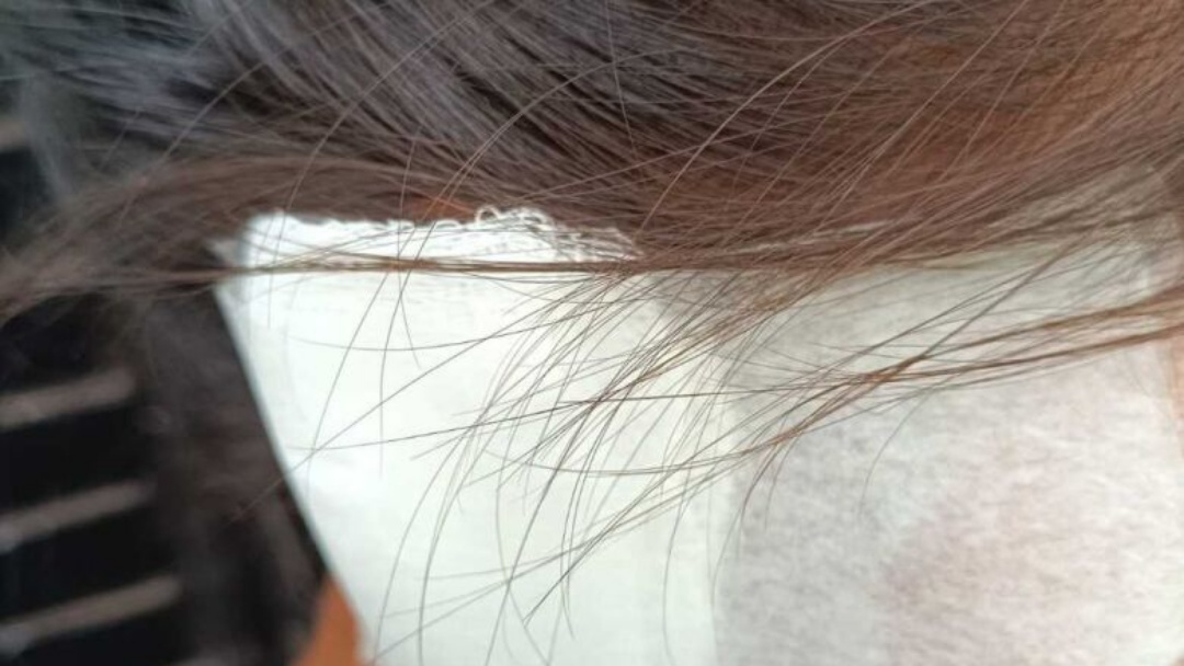 Mulher tem orelha arrancada na mordida pelo companheiro ap&oacute;s discuss&atilde;o