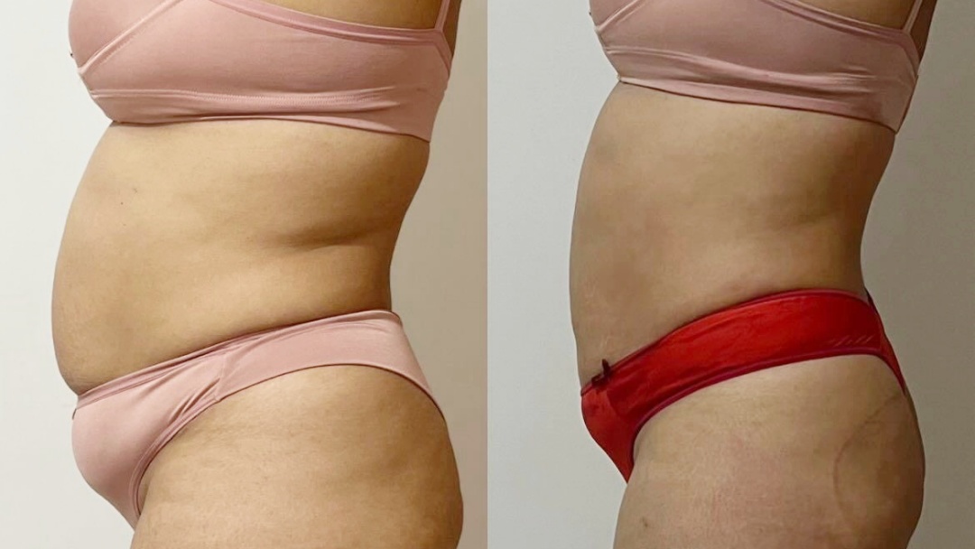 Exagerou nas comidas de fim de ano? Combo corporal promete resultados vis&iacute;veis e recupera&ccedil;&atilde;o das medidas