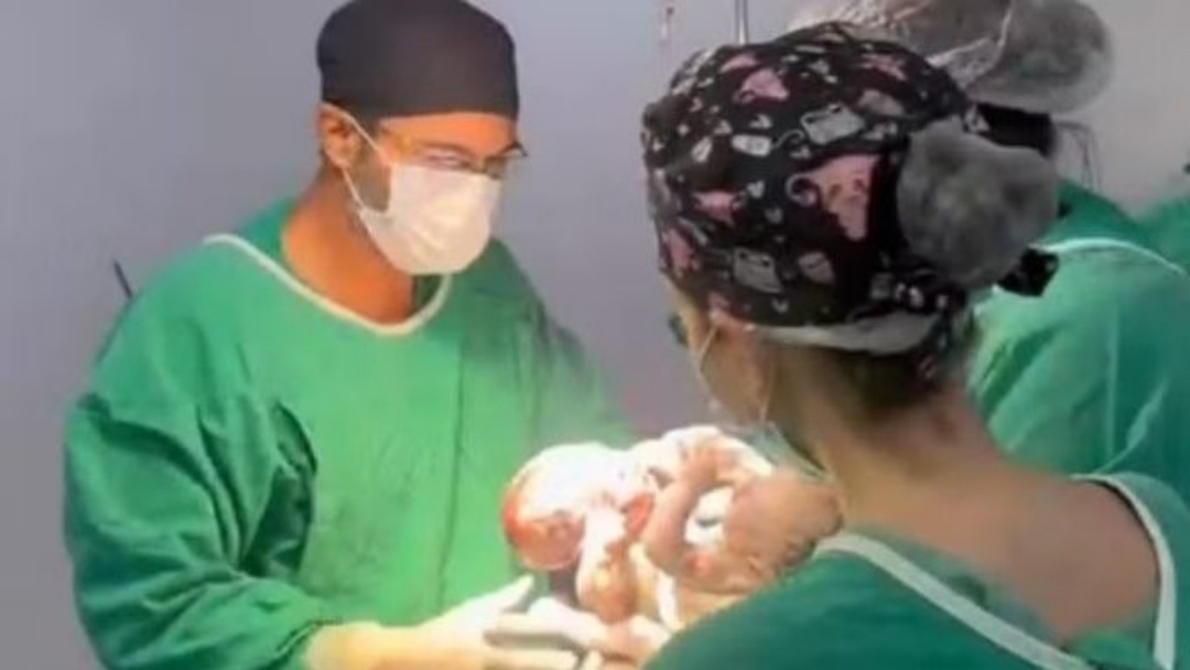 Gêmeos siameses recém-nascidos morrem em Goiás após cirurgias