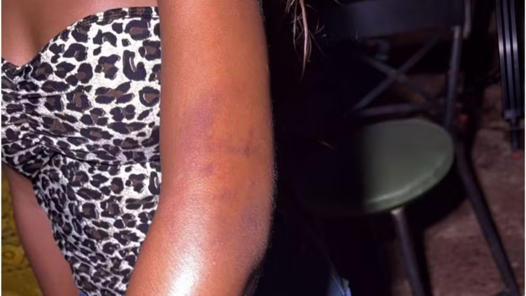 Menina de 15 anos agredida por PM diz sentir dores e que n&atilde;o recebeu ajuda ap&oacute;s agress&atilde;o no Carnaval