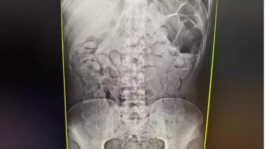 Boliviana &eacute; presa ap&oacute;s 7 dias com 90 c&aacute;psulas de coca&iacute;na no est&ocirc;mago