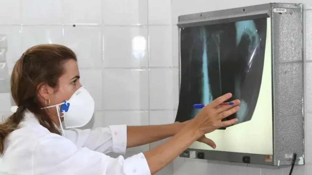 OMS recomenda testes de diagn&oacute;stico r&aacute;pido para erradicar tuberculose