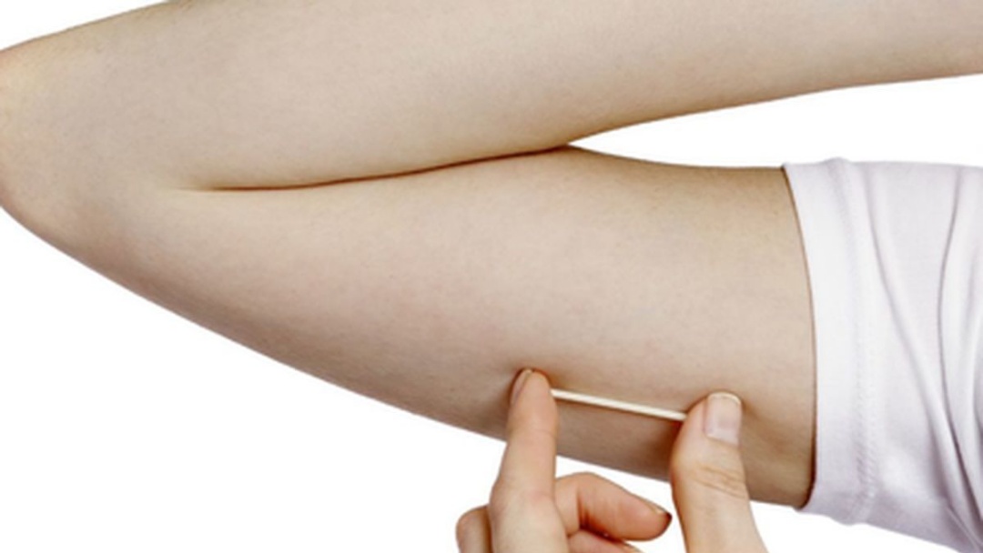 Sidrolândia receberá 150 implantes contraceptivos aplicados sob a pele