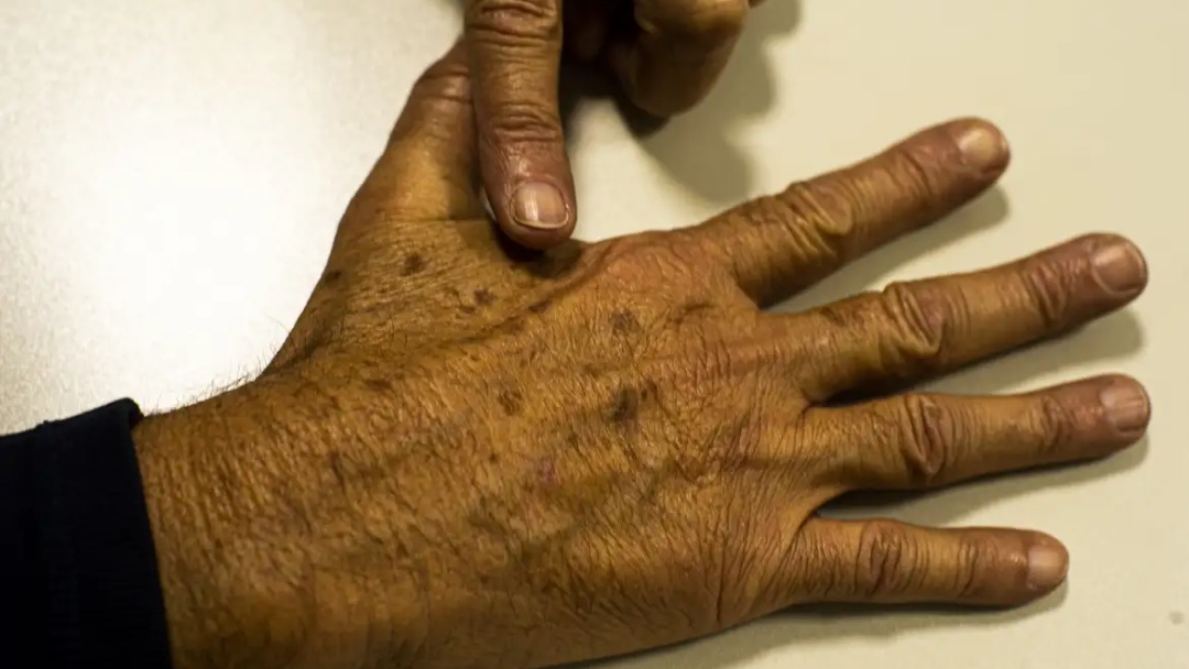 Desinformação sobre câncer de pele afeta diagnóstico