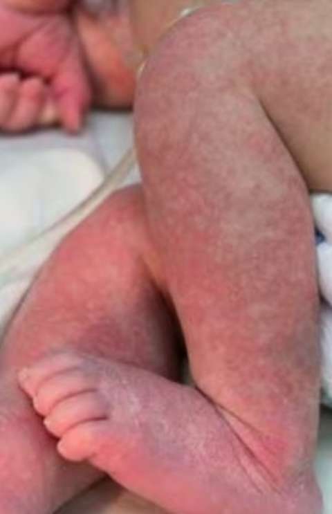 Em 24h, Dourados tem sessenta novos casos confirmados de chikungunya