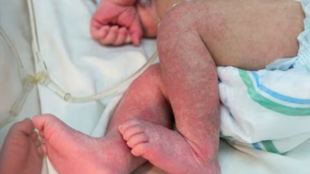 Em 24h, Dourados tem sessenta novos casos confirmados de chikungunya