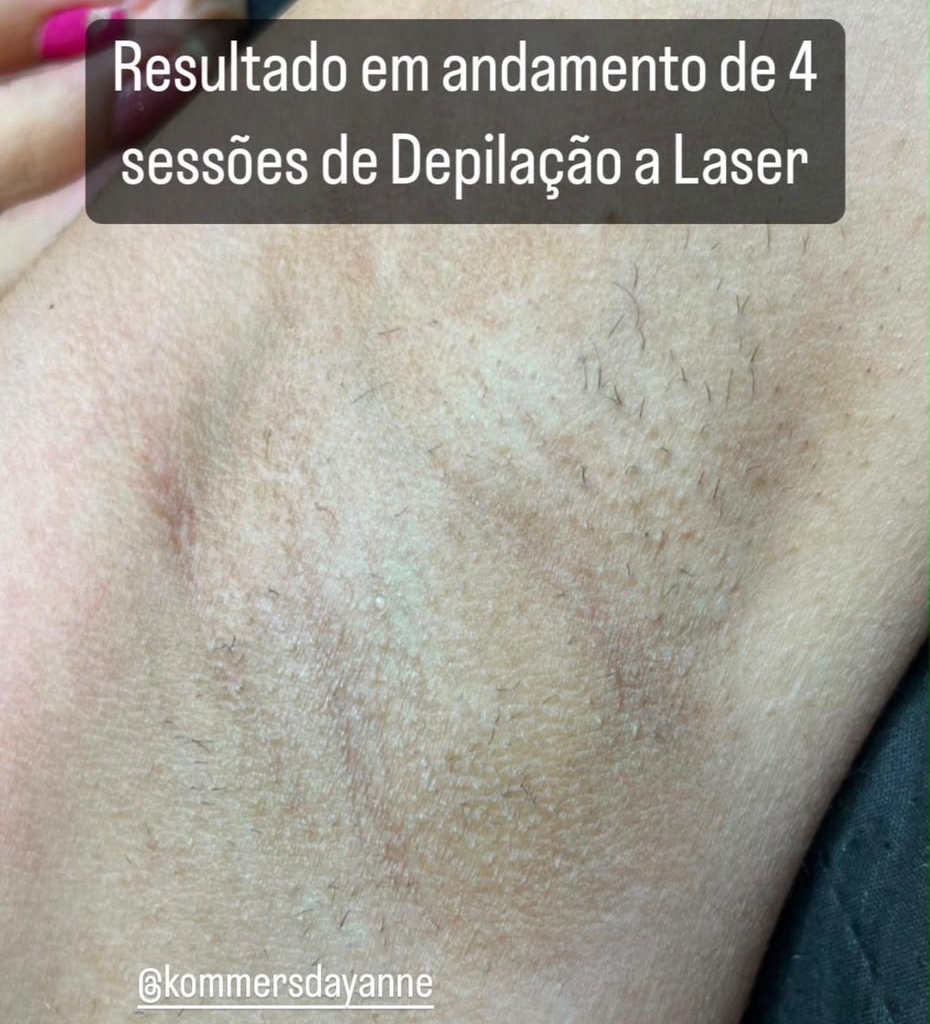 Laser Day oferece depila&ccedil;&atilde;o a laser com atendimento especializado e vagas limitadas